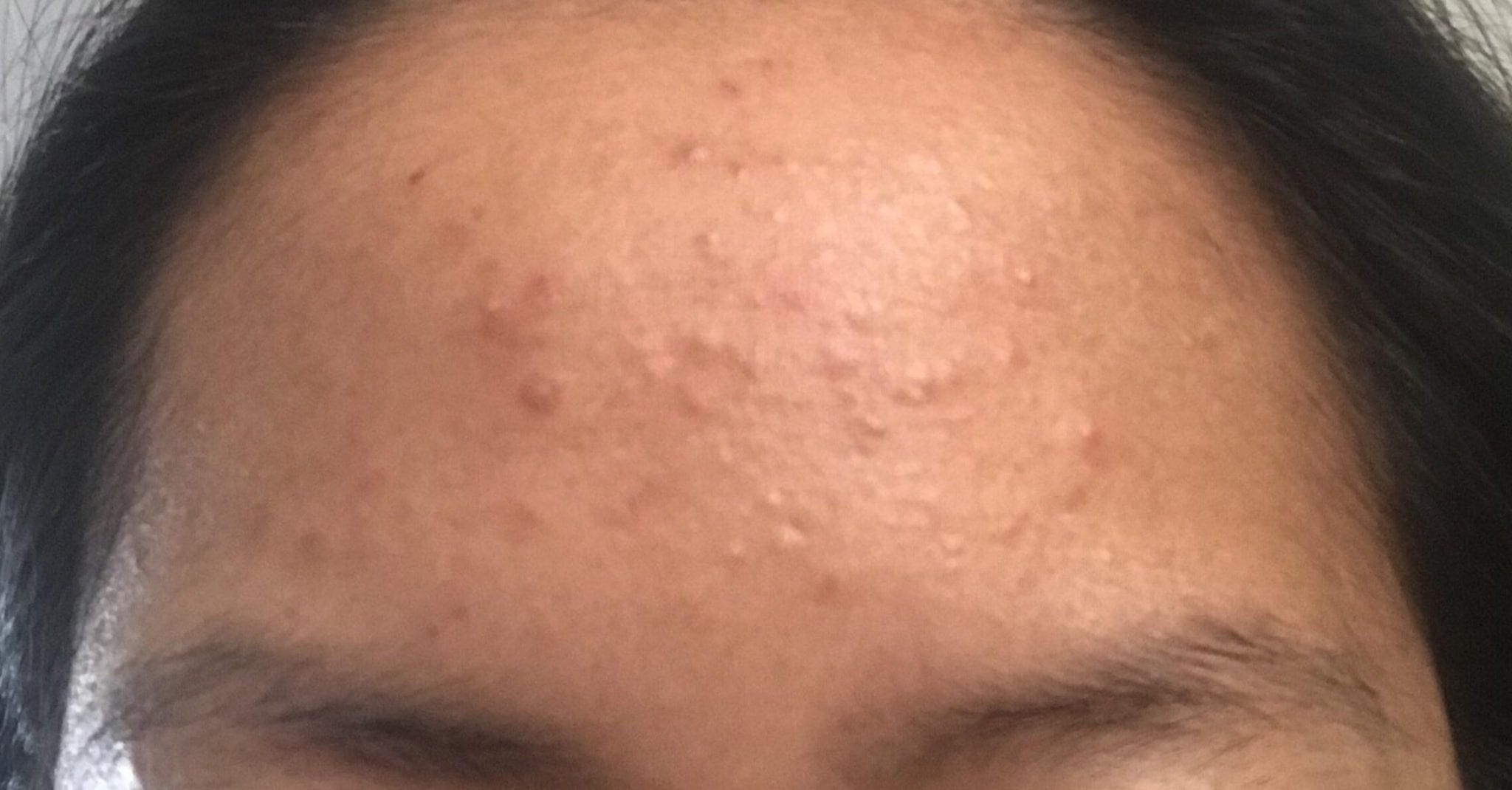 how-to-easily-get-rid-of-forehead-acne-market-share-group