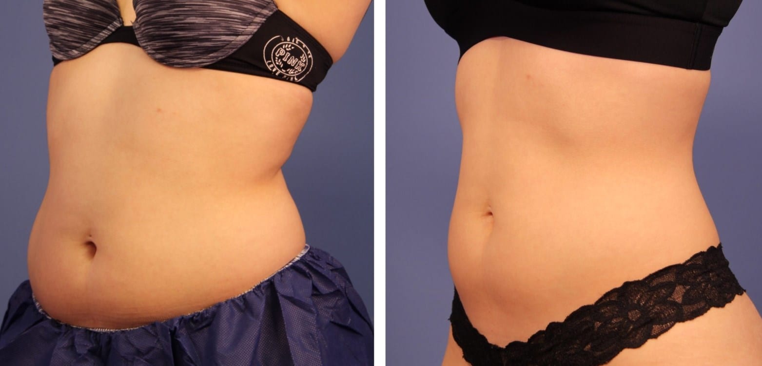 coolsculpting-cost-results-and-info-2023-edition-market-share-group