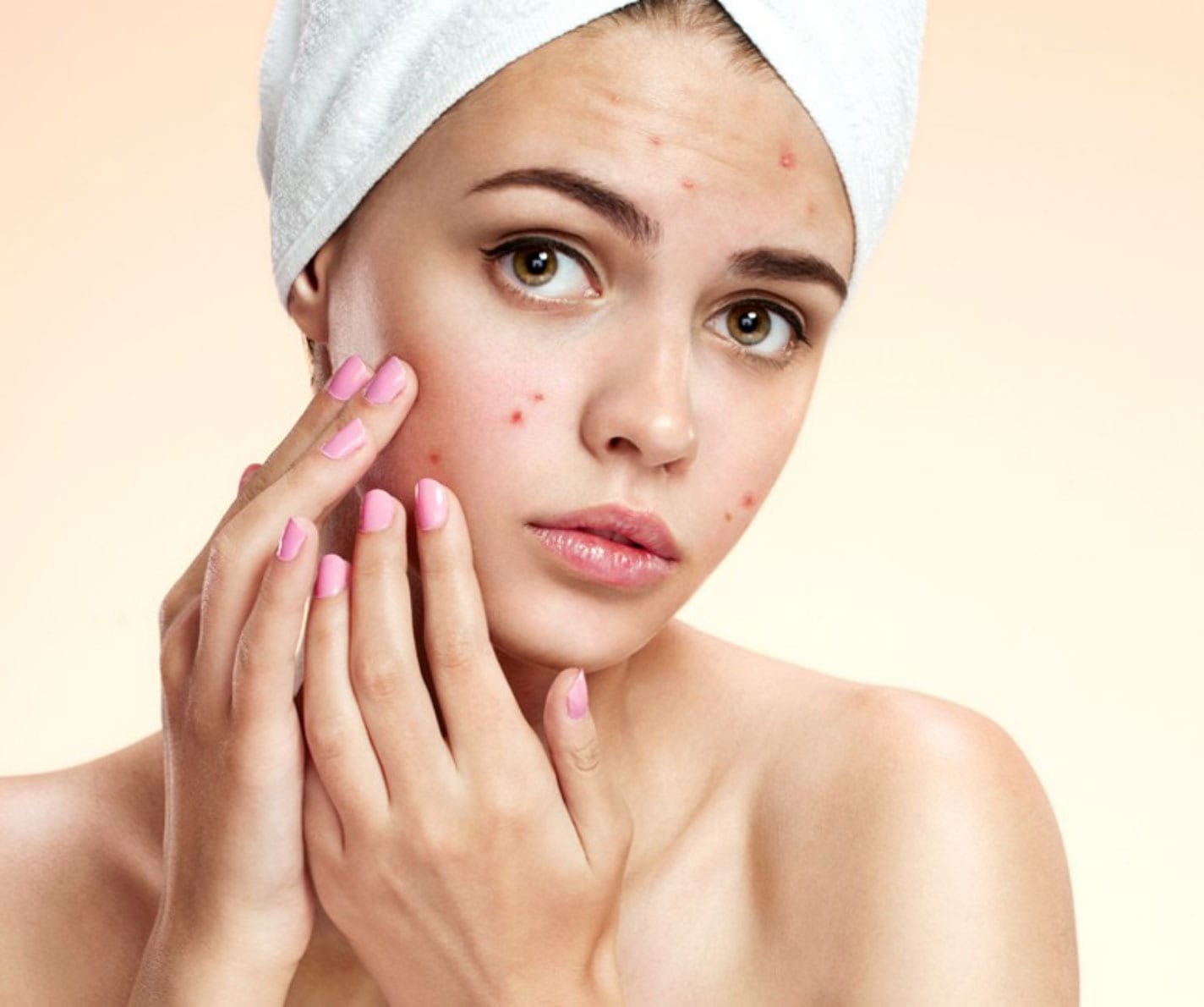 How to Fight Acne Naturally - Market Share Group